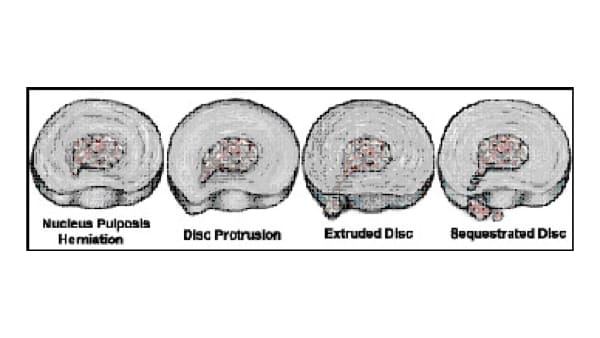hernie discale decompression neuro vertebrale decompression vertebrale cabinet osteopathie florent schoofs osteopathe paris 7 osteopathie 75007