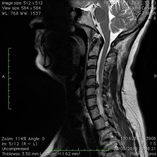cas patients florent schoofs osteopathe paris 7 decompression neurovertebrale paris 7 1