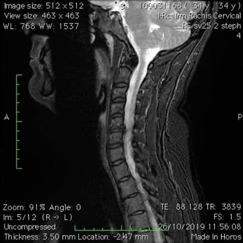 cas patients florent schoofs osteopathe paris 7 decompression neurovertebrale paris 7 2