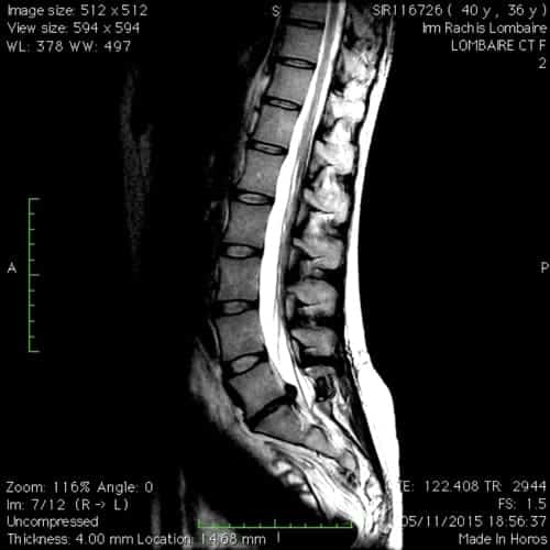 hernie discale l5s1 sciatique paralysante laminectomie partielle florent schoofs osteopathe paris 7 decompression neurovertebrale paris 7 1