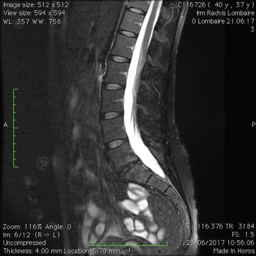 hernie discale l5s1 sciatique paralysante laminectomie partielle florent schoofs osteopathe paris 7 decompression neurovertebrale paris 7 3