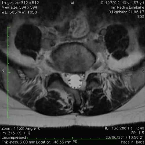 hernie discale l5s1 sciatique paralysante laminectomie partielle florent schoofs osteopathe paris 7 decompression neurovertebrale paris 7 4