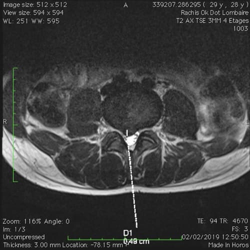 sciatique paralysante bilaterale lombalgie chronique florent schoofs osteopathe paris 7 decompression neurovertebrale paris 7 1