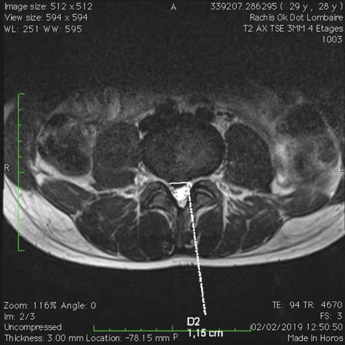 sciatique paralysante bilaterale lombalgie chronique florent schoofs osteopathe paris 7 decompression neurovertebrale paris 7 2