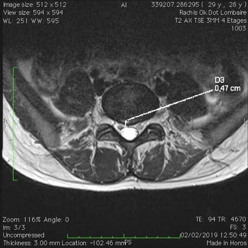sciatique paralysante bilaterale lombalgie chronique florent schoofs osteopathe paris 7 decompression neurovertebrale paris 7 3