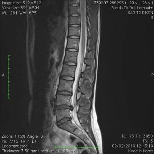 sciatique paralysante bilaterale lombalgie chronique florent schoofs osteopathe paris 7 decompression neurovertebrale paris 7 4