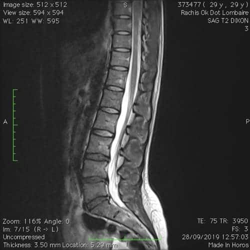 sciatique paralysante bilaterale lombalgie chronique florent schoofs osteopathe paris 7 decompression neurovertebrale paris 7 5