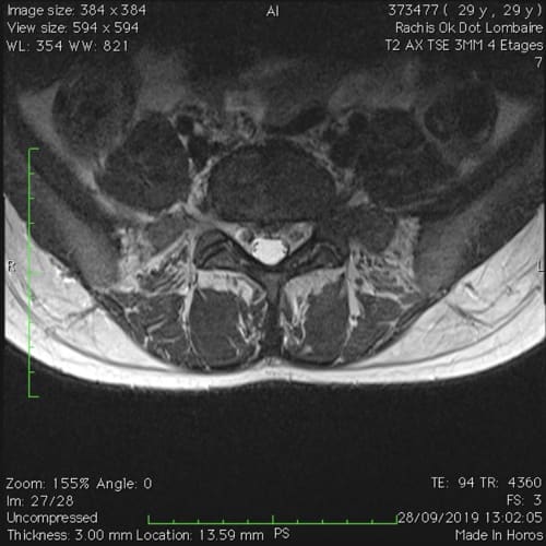 sciatique paralysante bilaterale lombalgie chronique florent schoofs osteopathe paris 7 decompression neurovertebrale paris 7 6