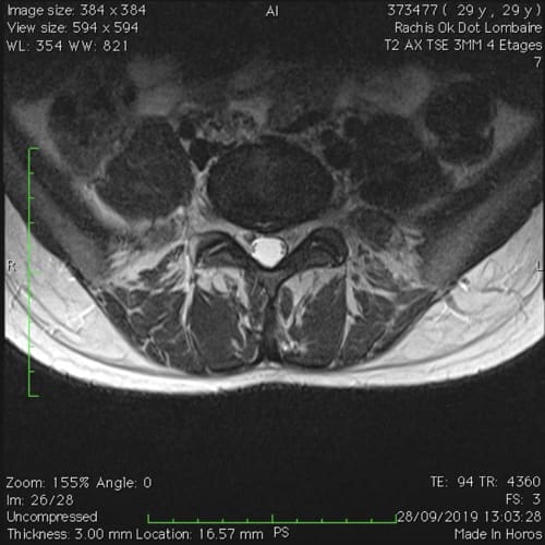 sciatique paralysante bilaterale lombalgie chronique florent schoofs osteopathe paris 7 decompression neurovertebrale paris 7 7