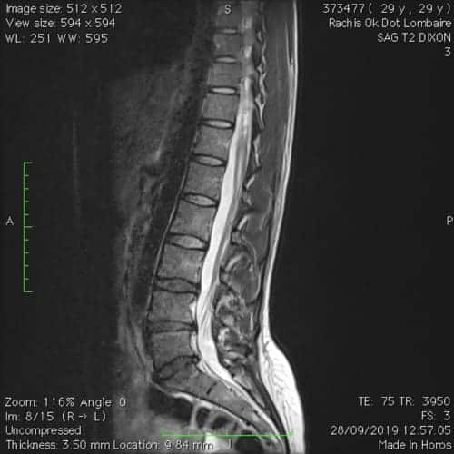 sciatique paralysante bilaterale lombalgie chronique florent schoofs osteopathe paris 7 decompression neurovertebrale paris 7 8